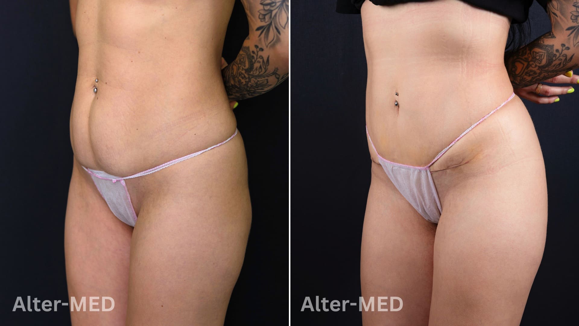 abdominoplastie image Abdominoplastie