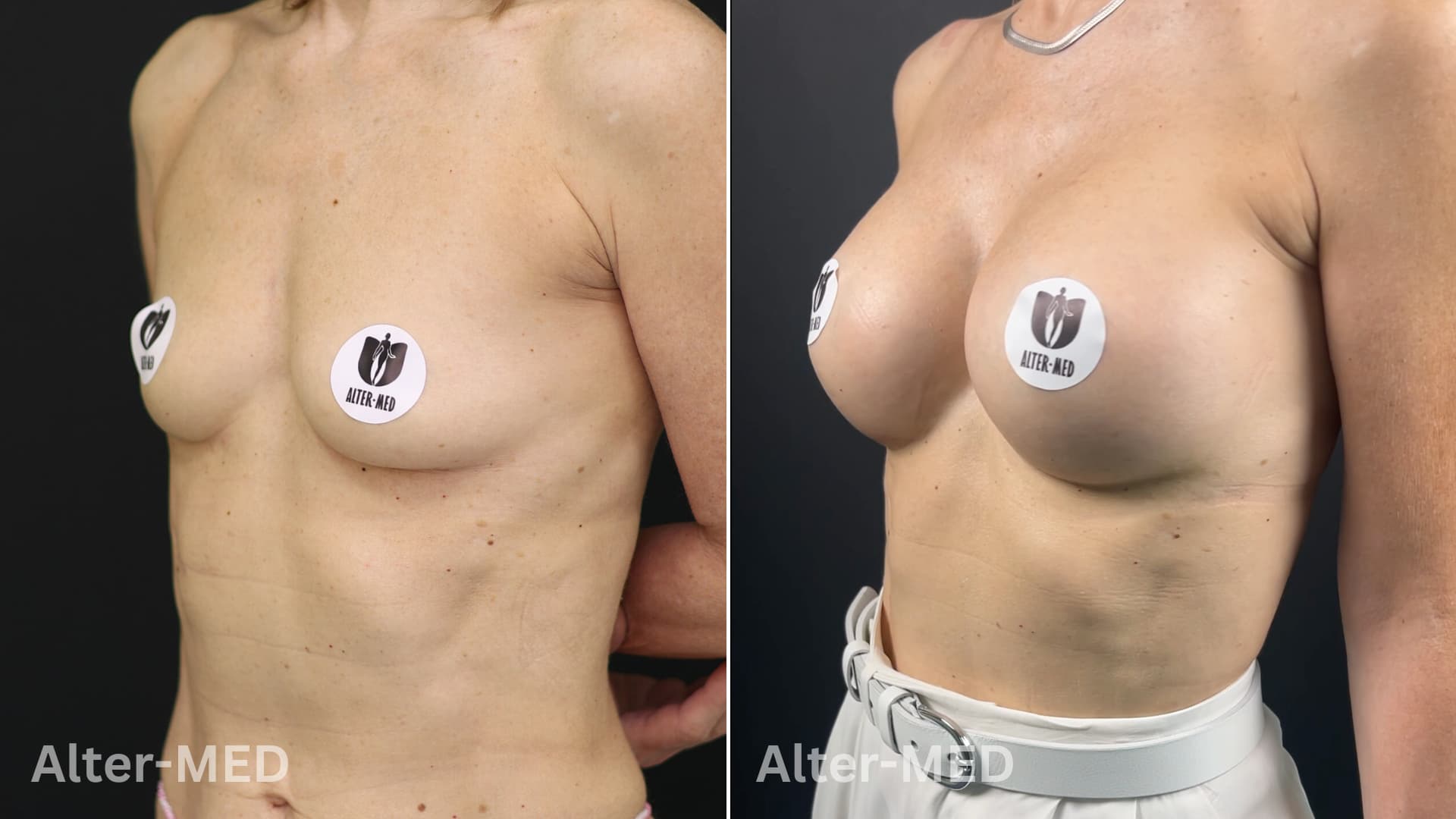 augmentare-mamara image Augmentare mamară