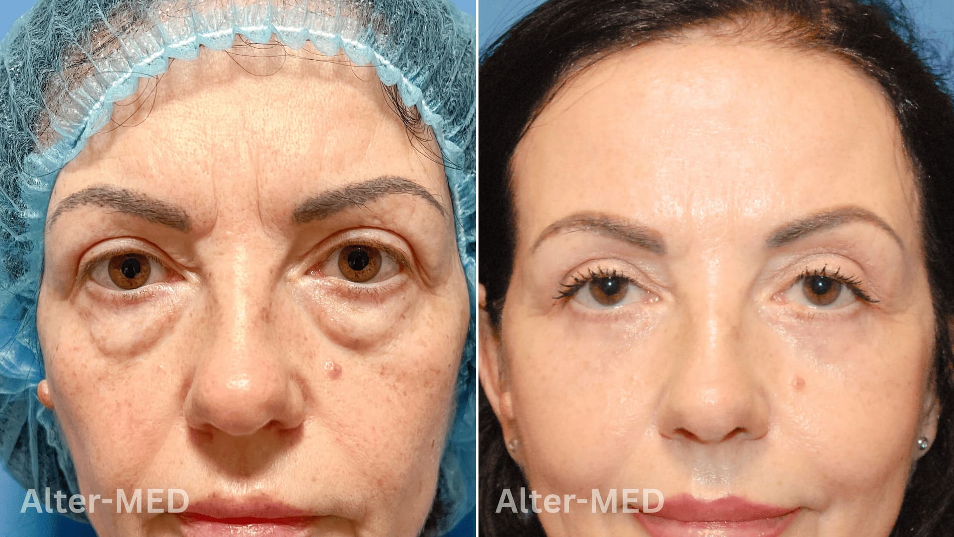 blefaroplastie image Blefaroplastie