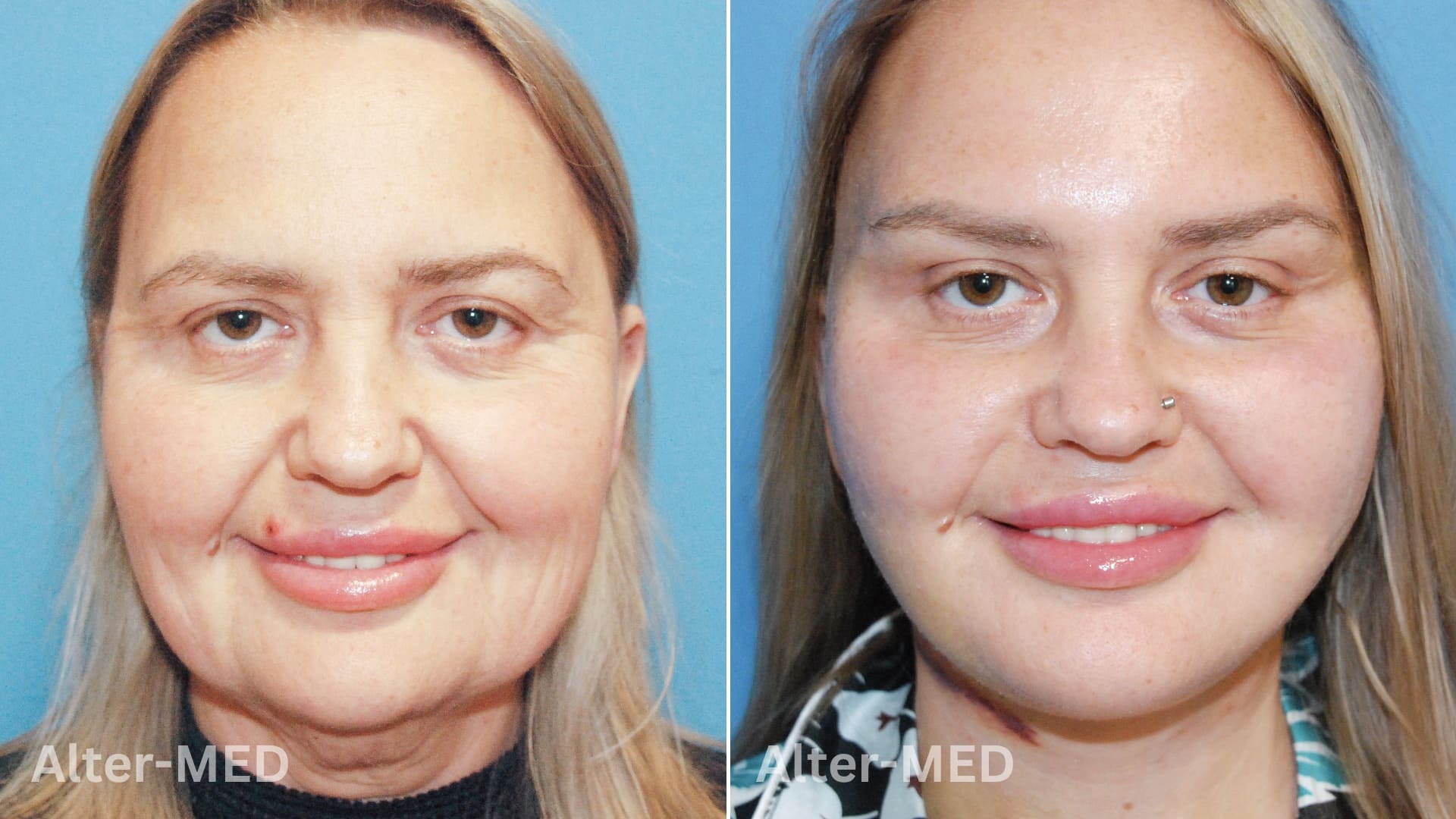 lifting-facial image Lifting Facial