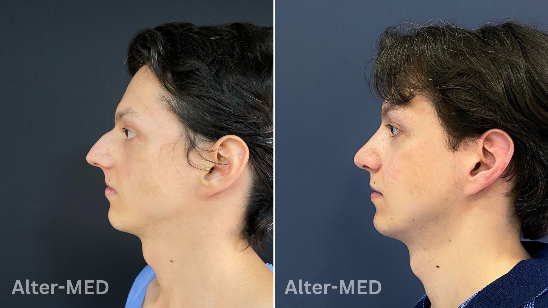 rinoplastie image Rinoplastie